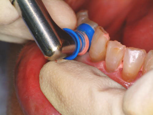 「カップ」にて下の前歯表面のPMTC