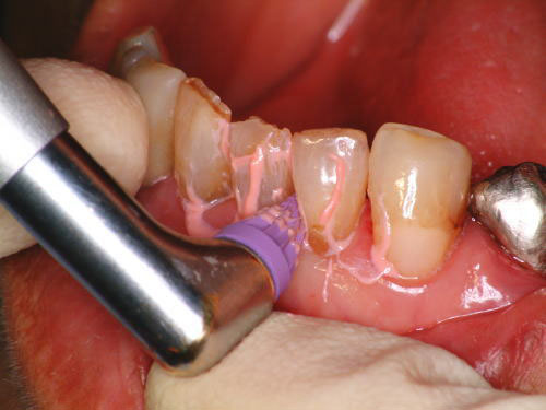 「コーン」にて下の前歯歯間をPMTC