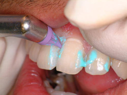 「コーン」にて上の前歯歯間をPMTC